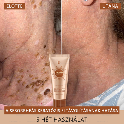 💟💟 FRISSARC™ fehérítő és folteltávolító arcmaszk